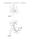 Implantable heart assist system and method of applying same diagram and image