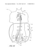 Implantable heart assist system and method of applying same diagram and image