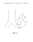 Implantable heart assist system and method of applying same diagram and image