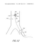 Implantable heart assist system and method of applying same diagram and image