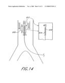 Implantable heart assist system and method of applying same diagram and image