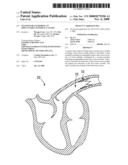 SYSTEM FOR ANCHORING AN IMPLANTABLE SENSOR IN A VESSEL diagram and image