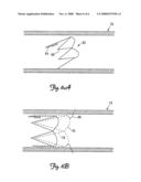 SYSTEM FOR ANCHORING AN IMPLANTABLE SENSOR IN A VESSEL diagram and image