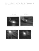 Photodynamic foam composition and sclerosis treatment diagram and image