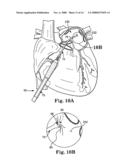 CARDIAC ABLATION AND ELECTRICAL INTERFACE SYSTEM AND INSTRUMENT diagram and image
