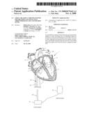 ATRIAL ABLATION CATHETER ADAPTED FOR TREATMENT OF SEPTAL WALL ARRHYTHMOGENIC FOCI AND METHOD OF USE diagram and image