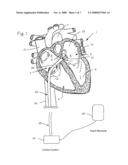 ATRIAL ABLATION CATHETER ADAPTED FOR TREATMENT OF SEPTAL WALL ARRHYTHMOGENIC FOCI AND METHOD OF USE diagram and image