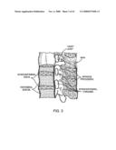 GUIDEWIRE EXCHANGE SYSTEMS TO TREAT SPINAL STENOSIS diagram and image