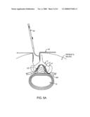 GUIDEWIRE EXCHANGE SYSTEMS TO TREAT SPINAL STENOSIS diagram and image