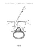 GUIDEWIRE EXCHANGE SYSTEMS TO TREAT SPINAL STENOSIS diagram and image