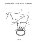 GUIDEWIRE EXCHANGE SYSTEMS TO TREAT SPINAL STENOSIS diagram and image