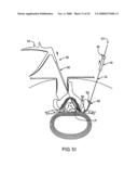 GUIDEWIRE EXCHANGE SYSTEMS TO TREAT SPINAL STENOSIS diagram and image