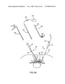 GUIDEWIRE EXCHANGE SYSTEMS TO TREAT SPINAL STENOSIS diagram and image