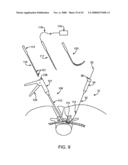 GUIDEWIRE EXCHANGE SYSTEMS TO TREAT SPINAL STENOSIS diagram and image