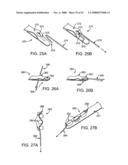 GUIDEWIRE EXCHANGE SYSTEMS TO TREAT SPINAL STENOSIS diagram and image