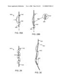 GUIDEWIRE EXCHANGE SYSTEMS TO TREAT SPINAL STENOSIS diagram and image