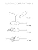 GUIDEWIRE EXCHANGE SYSTEMS TO TREAT SPINAL STENOSIS diagram and image