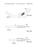 GUIDEWIRE EXCHANGE SYSTEMS TO TREAT SPINAL STENOSIS diagram and image