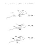 GUIDEWIRE EXCHANGE SYSTEMS TO TREAT SPINAL STENOSIS diagram and image