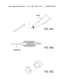 GUIDEWIRE EXCHANGE SYSTEMS TO TREAT SPINAL STENOSIS diagram and image