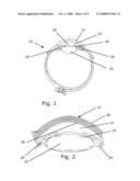 Capsular Ring diagram and image