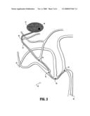 Intraoperative guidance for endovascular interventions via three-dimensional path planning, x-ray fluoroscopy, and image overlay diagram and image