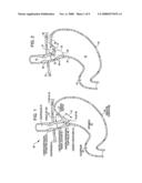 Transoral endoscopic gastroesophageal flap valve restoration device, assembly, system and method diagram and image