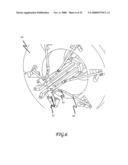 Assisted Apparatus for Anastomosis and Method Thereby of Reconnecting the Urethra to the Bladder After Removal of the Prostate During a Prostatectomy diagram and image