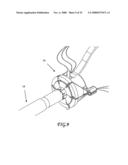 Assisted Apparatus for Anastomosis and Method Thereby of Reconnecting the Urethra to the Bladder After Removal of the Prostate During a Prostatectomy diagram and image