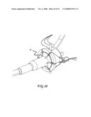 Assisted Apparatus for Anastomosis and Method Thereby of Reconnecting the Urethra to the Bladder After Removal of the Prostate During a Prostatectomy diagram and image