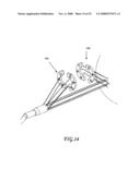 Assisted Apparatus for Anastomosis and Method Thereby of Reconnecting the Urethra to the Bladder After Removal of the Prostate During a Prostatectomy diagram and image