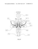 Assisted Apparatus for Anastomosis and Method Thereby of Reconnecting the Urethra to the Bladder After Removal of the Prostate During a Prostatectomy diagram and image