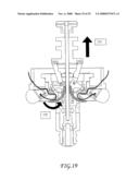 Assisted Apparatus for Anastomosis and Method Thereby of Reconnecting the Urethra to the Bladder After Removal of the Prostate During a Prostatectomy diagram and image