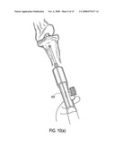 Suture tensioning device diagram and image