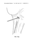 Suture tensioning device diagram and image