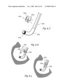 Methods and Apparatus for Treating Disorders of the Ear Nose and Throat diagram and image