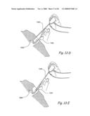 Methods and Apparatus for Treating Disorders of the Ear Nose and Throat diagram and image