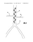 MEDICAL FILTER WITH PARTIAL BASKETS diagram and image