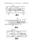 CROSSOVER RETRIEVABLE MEDICAL FILTER diagram and image