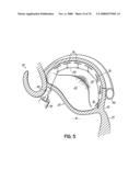 METHOD OF HEART VALVE REPAIR diagram and image