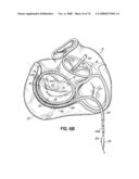 METHOD OF HEART VALVE REPAIR diagram and image