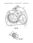 METHOD OF HEART VALVE REPAIR diagram and image