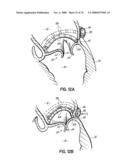 METHOD OF HEART VALVE REPAIR diagram and image