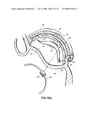 METHOD OF HEART VALVE REPAIR diagram and image