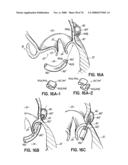 METHOD OF HEART VALVE REPAIR diagram and image