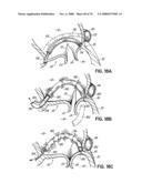 METHOD OF HEART VALVE REPAIR diagram and image