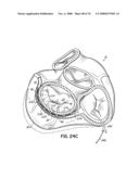 METHOD OF HEART VALVE REPAIR diagram and image