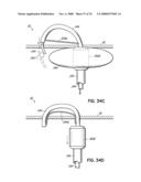 METHOD OF HEART VALVE REPAIR diagram and image