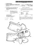 Prostheses, Tools and Methods for Replacement of Natural Facet Joints With Artificial Facet Joint Surfaces diagram and image