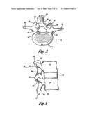 Prostheses, Tools and Methods for Replacement of Natural Facet Joints With Artificial Facet Joint Surfaces diagram and image